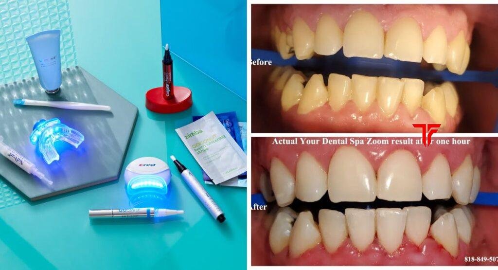 best at home teeth whitening kits
